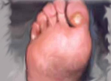 Que ungüento cura el hongo inguinal
