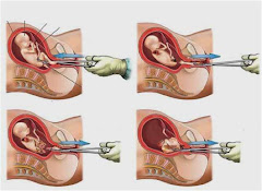 Pasos del Aborto