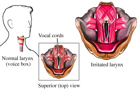 Nursing Care Plan | NCP Laryngitis