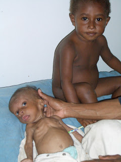 Children With Marasmus
