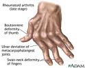 Severe Rheumatoid arthritis hands