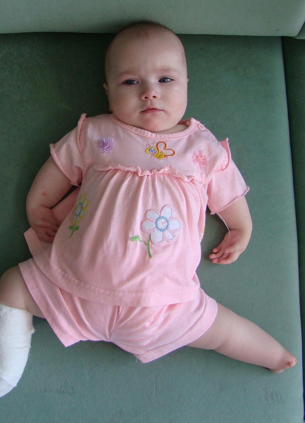 OMIM Entry 601680 ARTHROGRYPOSIS DISTAL TYPE 2B DA2B