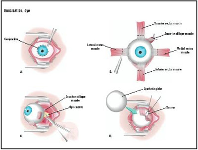 Studying Animals: Enucleation - the surgical removal of the eye.