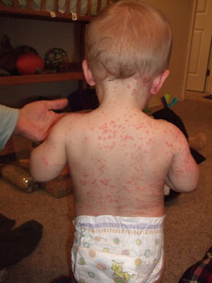 Amoxicillin Allergy - Day 2