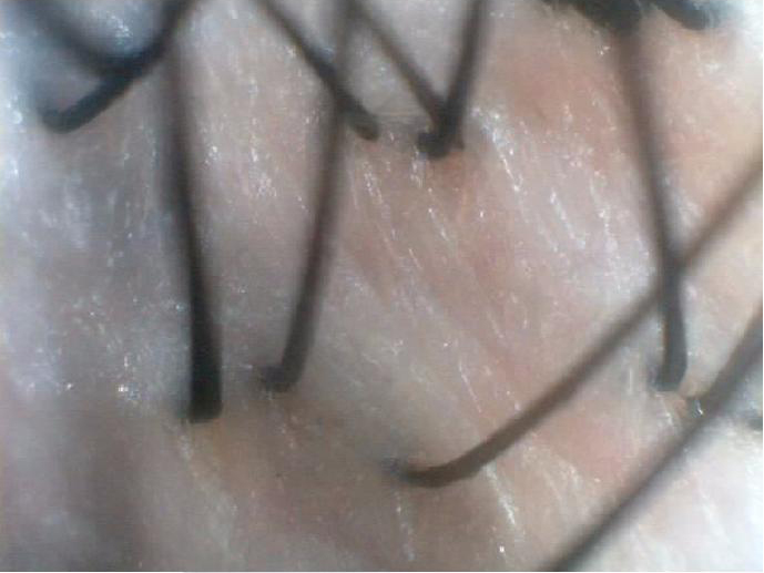 normal scalp
