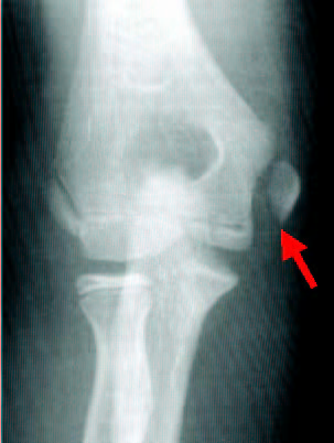 FTK Sports Medicine: UCL Tear