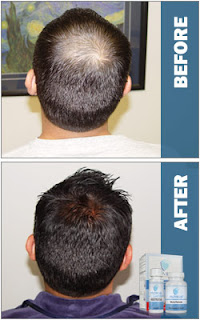 hair thinning treatment