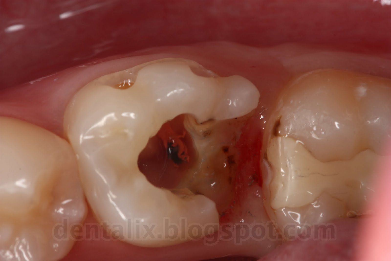 Muela rota? - Foros Perú