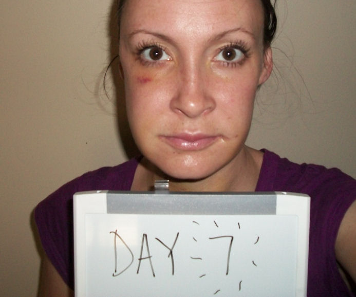 Double Jaw Surgery Day 7 official pics