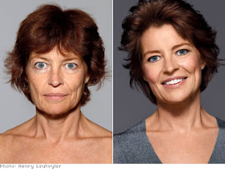 agespots