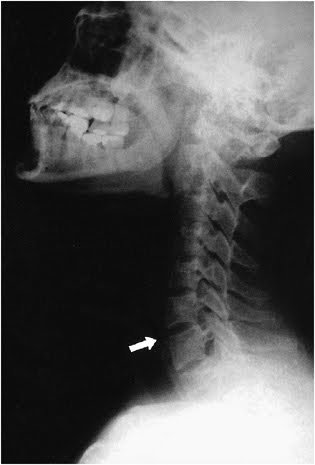 cervical neck curvature normal spine abnormal reversal curve lordosis straight loss kyphosis symptoms curves healthy military pain clinic incorrect lordotic