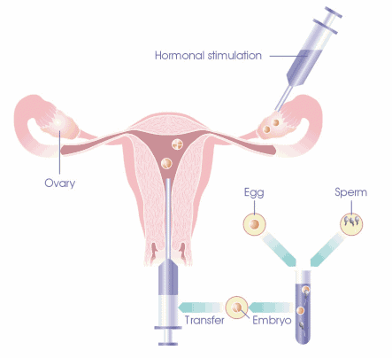 Egg Collection Ivf
