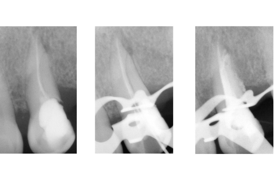 CASOS CLÍNICOS ENDODONCIA