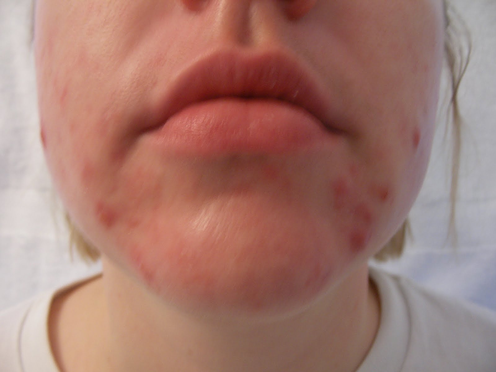 buy accutane without