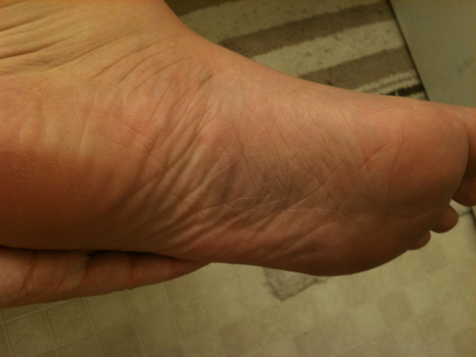 Dr scholl�s sneakers walmart, bruised arch of foot