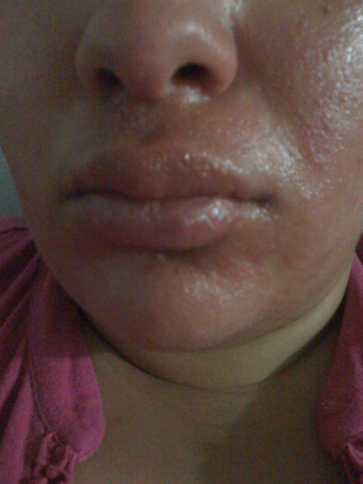 mango rash: Mango: The forbidden fruit