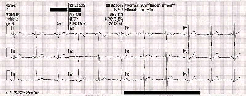 Ecg Wiki