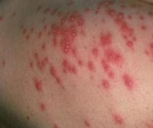 ANSWERS: Pseudomonas folliculitis?
