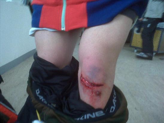 Hematoma On Knee