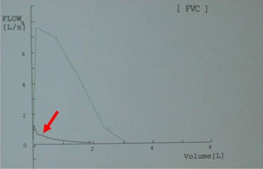 Phimaimedicine 431. Mixed pattern of spirometry
