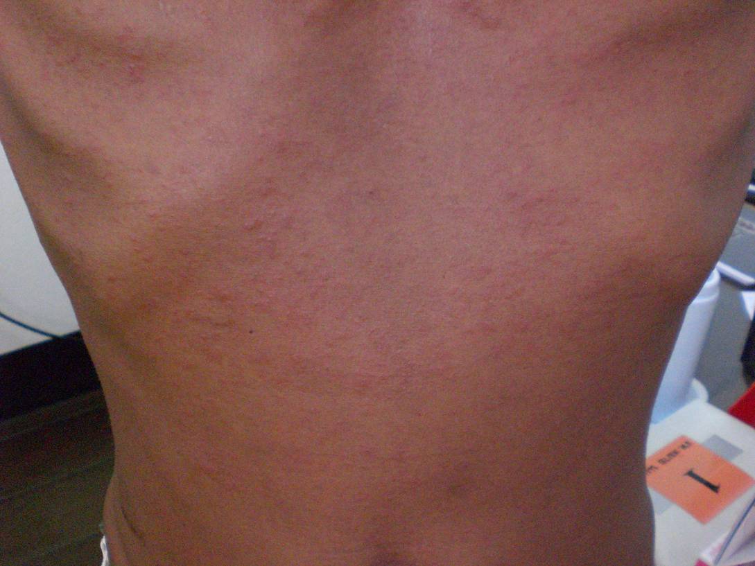 Tb Rash