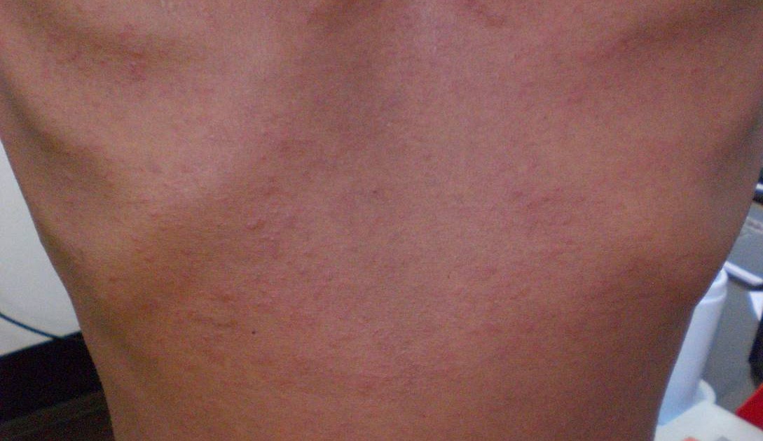 Phimaimedicine 474. ชาย 42 ปี Pulmonary TB, รับประทานยา TB 1 สัปดาห์