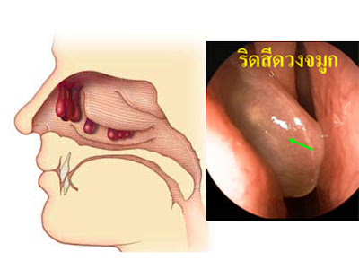 Nasal Inverted Papilloma
