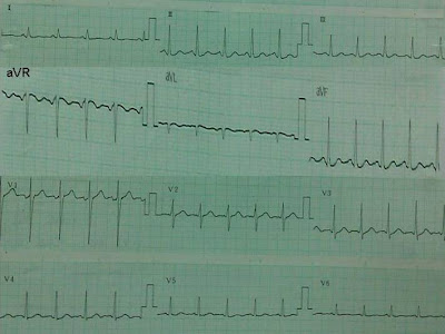 View การติด Lead Ekg V3R V4R Background