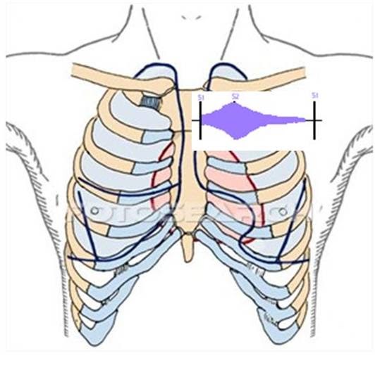 Phimaimedicine 703. Patent ductus arteriosus with pregnancy