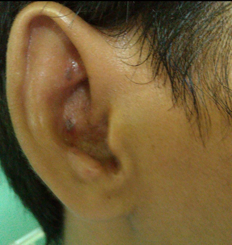 Phimaimedicine 705. Ramsay hunt syndrome