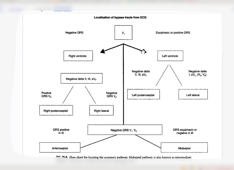 ECG An Easier Way Of Learning WPW localization of the accessory pathway