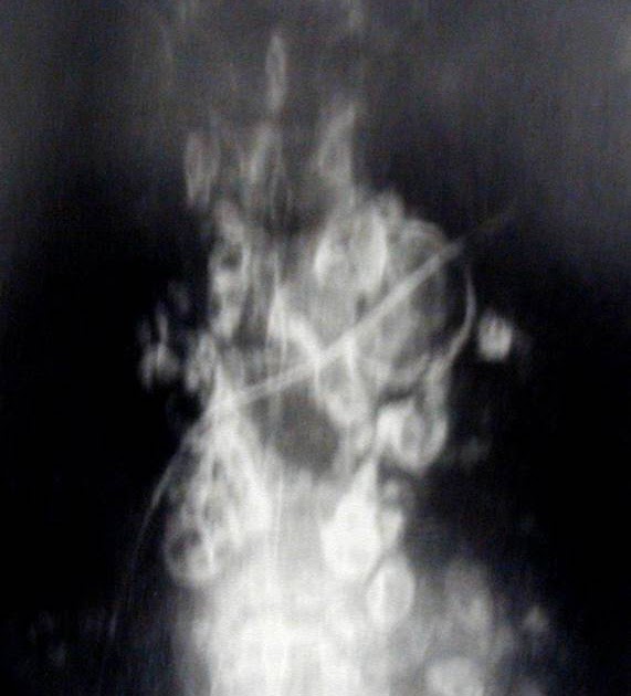 atlas of medicine egg shell calcification