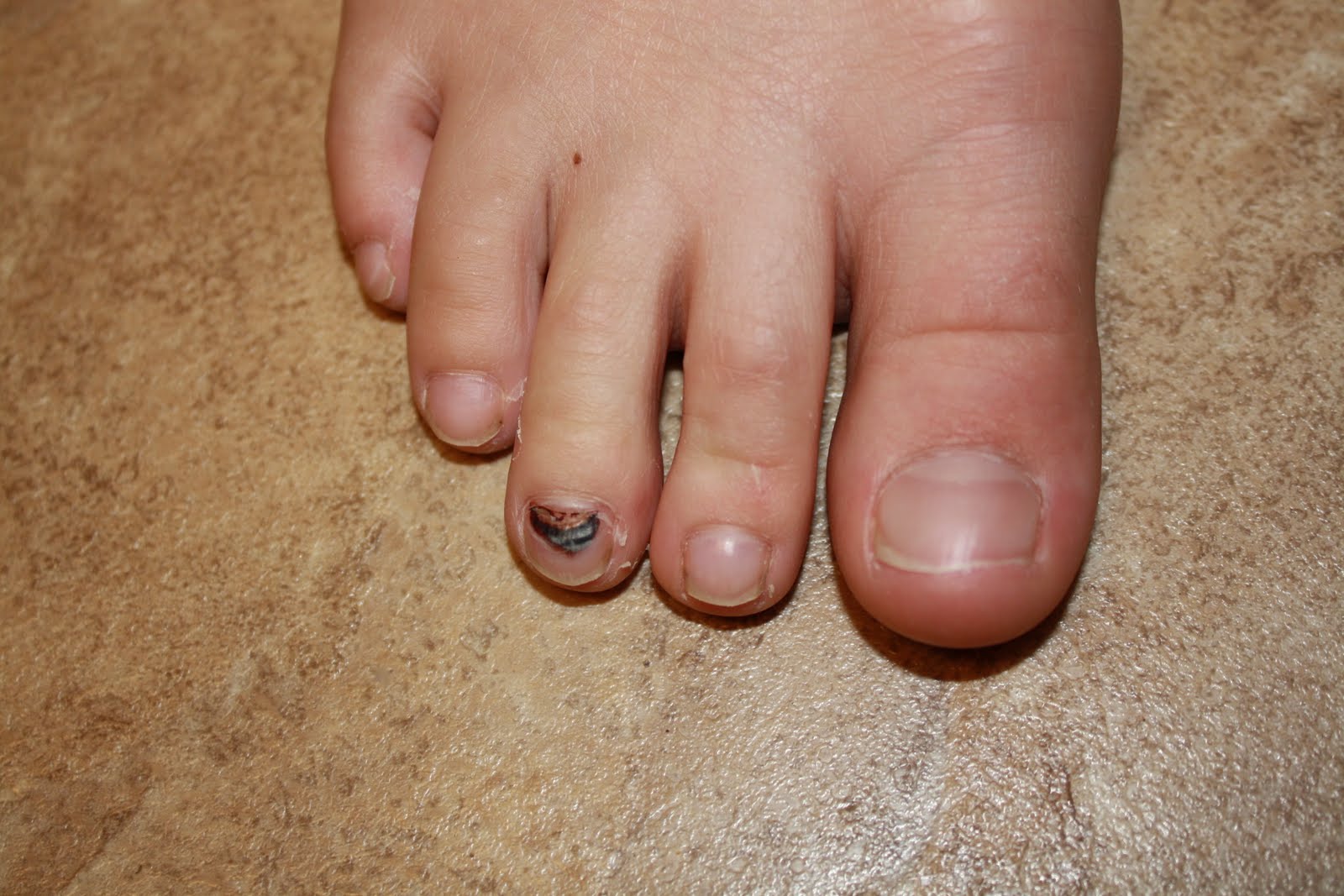 Do Hammer Toes Cause Numbness Roselee Zajdel