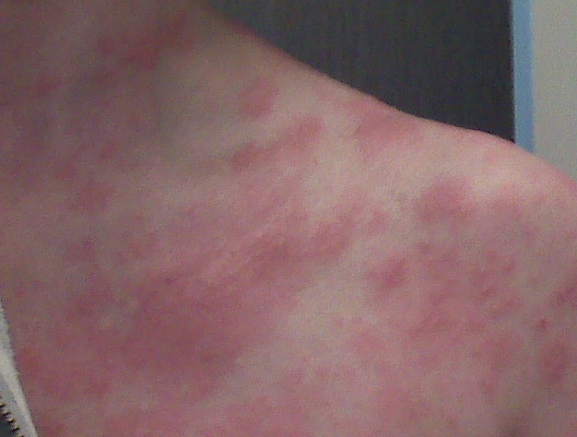 can dogs get shingles what does shingles look like on legs breeds picture can dogs get shingles what does shingles look like on legs breeds picture