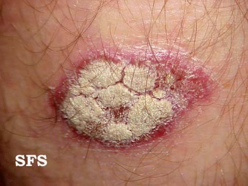 [psoriasis6.JPG]
