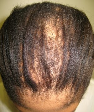 [mild-cicatricial-alopecia.jpg]