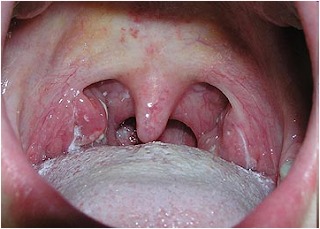 Diagnosing Strep Throat Tools