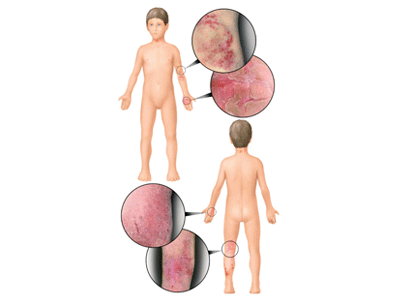 Itching is an intense, itching in anus. Itching is an intense,