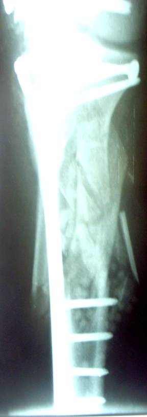Distal Femur Fracture Knee Replacement and Sports Surgery-4.bp.blogspot.com