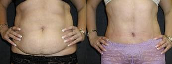 abdominoplasty photo