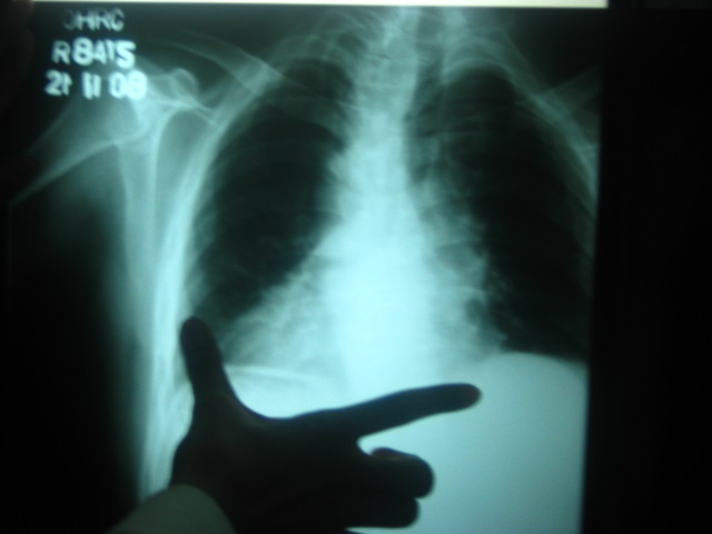 dextroposición