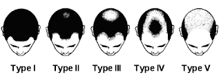 Male Pattern Baldness