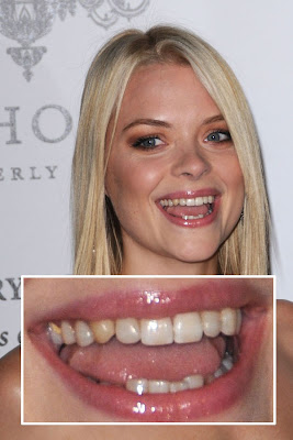 Celebrity Perfect Teeth