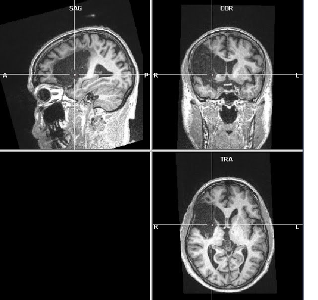 fmri at 3 years