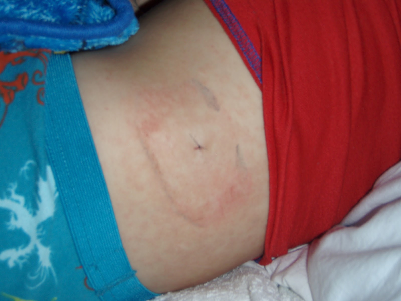 Salt Water Kure 5C16 Rash day 7 Bustin out.....again!