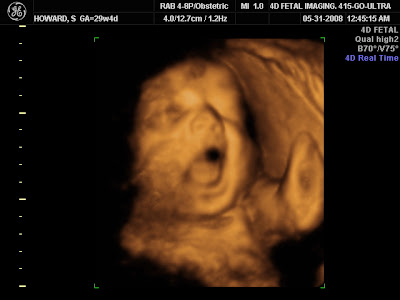 Project Howard: 3D Ultrasound o...