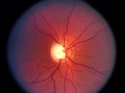 Glaucoma y Cannabis Glaucoma+ocular