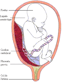 Image Result For Decollement Du Placenta Image Result For Decollement Du Placenta