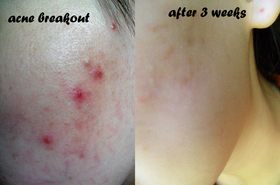 Journey on Beauty : My never ending battle with Acne/Pimple Journey on Beauty : My never ending battle with Acne/Pimple