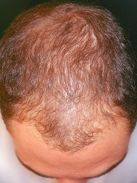 El medio público de la reconstitución de los cabello a los hombres